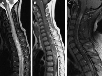 Chàng trai bị bệnh viêm tuỷ cột sống cần được giúp đỡ